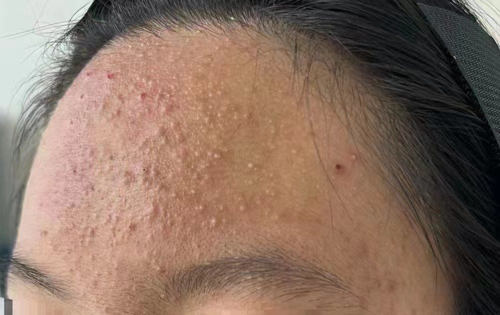 92青春期痘痘由额头开始97如果不控制会发展到脸颊 下巴 ,然后