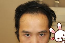 -大麦微针植发丨全国连锁