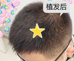 -大麦微针植发全国连锁