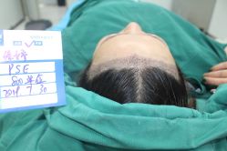 -大麦微针植发丨全国连锁