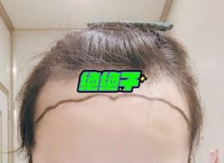 -大麦微针植发全国连锁