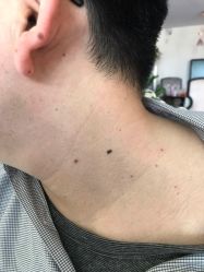 -美丽人生祛斑扁平疣汗管瘤中心