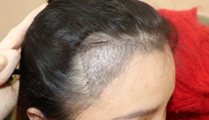 -大麦微针植发全国连锁