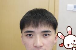 -大麦微针植发丨全国连锁