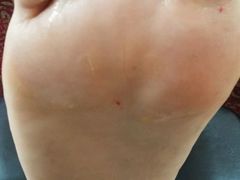 -祖传修脚甲沟炎灰指甲鸡眼