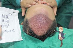 -大麦微针植发丨全国连锁