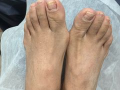 -世龙世家灰指甲鸡眼脚气甲沟炎跖疣护理(通州店)