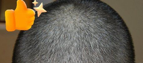 -大麦微针植发丨全国连锁