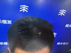 -雍禾植发全国连锁