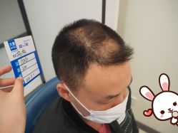 -大麦微针植发丨全国连锁