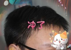 -大麦微针植发全国连锁