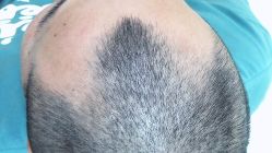 -雍禾植发全国连锁