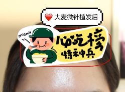 -大麦微针植发全国连锁