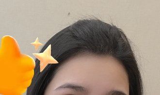 -大麦微针植发丨全国连锁