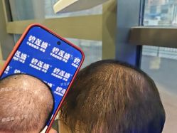 -碧莲盛·不剃发植发