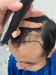 -大麦微针植发全国连锁