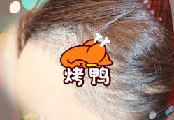 -大麦微针植发全国连锁