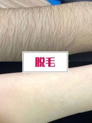 -薇兰专业脱毛连锁机构