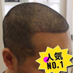 -大麦微针植发丨全国连锁