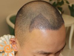 -大麦微针植发丨全国连锁