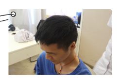 -大麦微针植发全国连锁