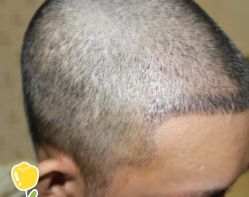 -大麦微针植发丨全国连锁