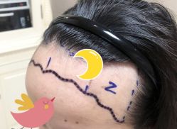 -大麦微针植发全国连锁