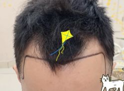 -大麦微针植发全国连锁