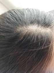 -大麦微针植发丨全国连锁