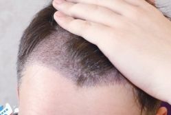 -大麦微针植发丨全国连锁