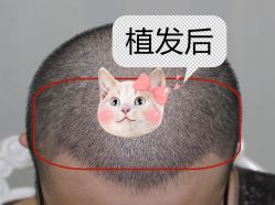 -大麦微针植发全国连锁