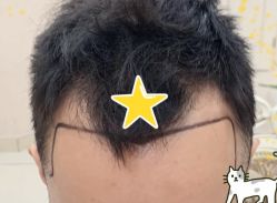 -大麦微针植发全国连锁