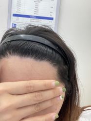 -大麦微针植发丨全国连锁