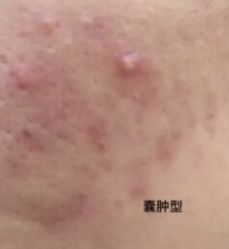 -苗方清颜痘肌研究所