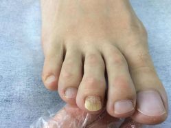 -德哥灰指甲脚气甲沟炎跖疣护理