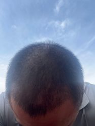 点击看大图 -新生植发·植养护一体