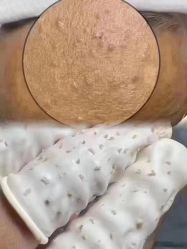 -瑶芳清颜草本祛痘