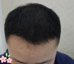 -大麦微针植发丨全国连锁