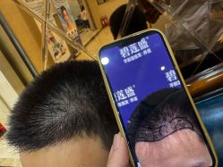 -碧莲盛·不剃发植发