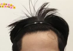 -大麦微针植发全国连锁