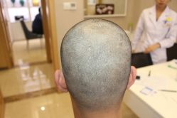 -大麦微针植发丨全国连锁