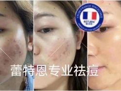 -蕾特恩专业祛痘·皮肤管理