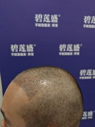 -碧莲盛·不剃发植发