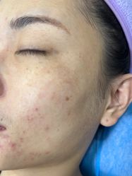体验前-美安心医美·美迪迈黄金微针·美拉美医疗美容