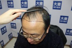 -大麦微针植发丨全国连锁