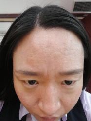-美丽人生祛斑扁平疣汗管瘤中心