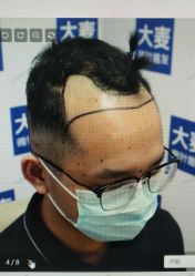 -大麦微针植发丨全国连锁