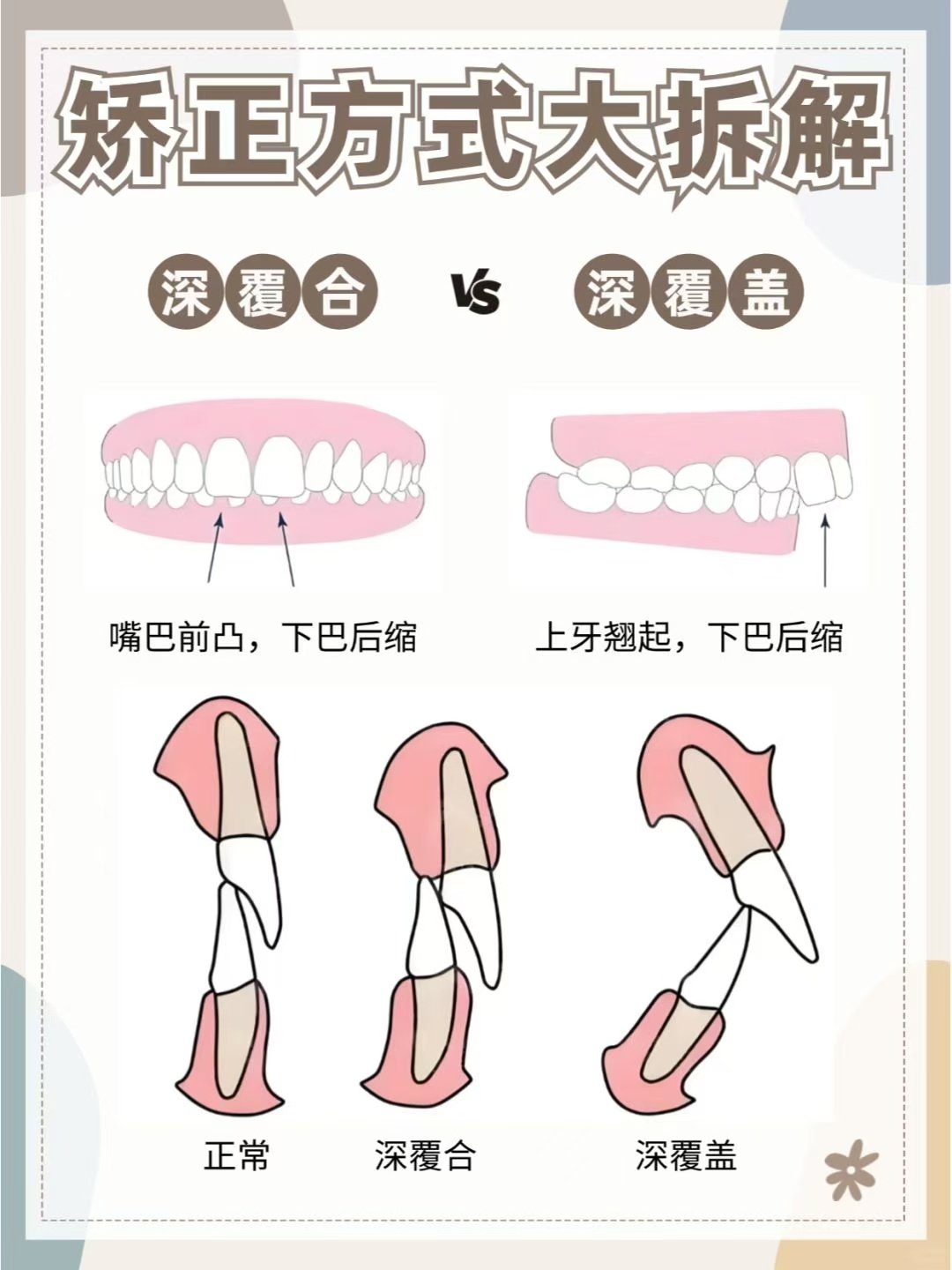 牙齿深覆合侧面图片