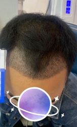 -大麦微针植发丨全国连锁