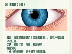 -黑马眼科·近视手术